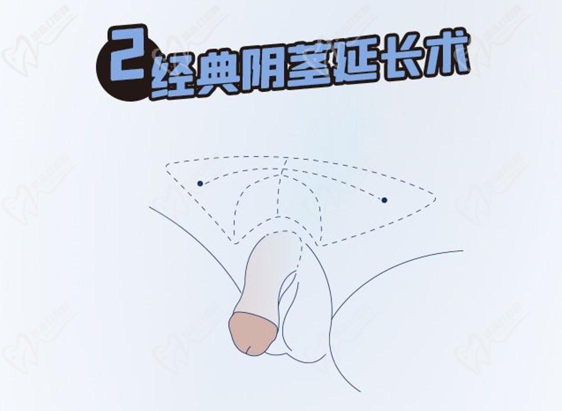 李世榮教授靠譜嗎？做延長手術(shù)2-5cm/增粗3cm很靠譜，出診價格高但超值