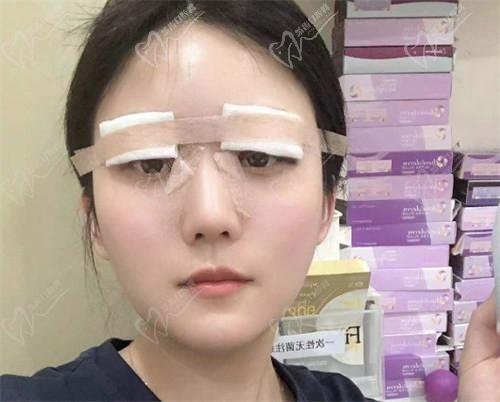 找杜園園做的8毫米寬的雙眼皮恢復(fù)圖來啦,術(shù)后30天,5個月和1年后的寬度圖片都有