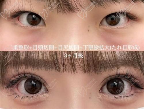 北京豐聯(lián)麗格醫(yī)療美容師麗麗修復(fù)雙眼皮怎么樣？肉條眼修復(fù)解決假寬深疤痕更隱形