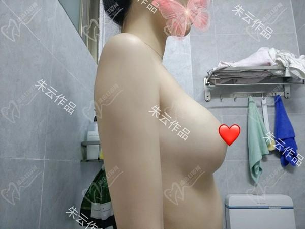 廣州朱云做胸怎么樣？是華南僅此一位做筋膜層隆胸的院長名咖技術(shù)精妙口碑高