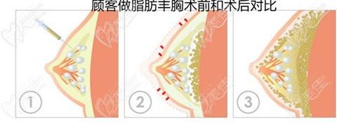 ?廣州朱云醫(yī)生擅長筋膜層微痛隆胸/不良胸修復(fù)/自體脂肪復(fù)合隆胸，技術(shù)真的特別膩害！