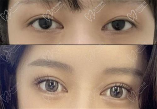 師麗麗的案例可信嗎?是不是營(yíng)銷(xiāo)出來(lái)的?師麗麗雙眼皮修復(fù)+內(nèi)眼角修復(fù)案例
