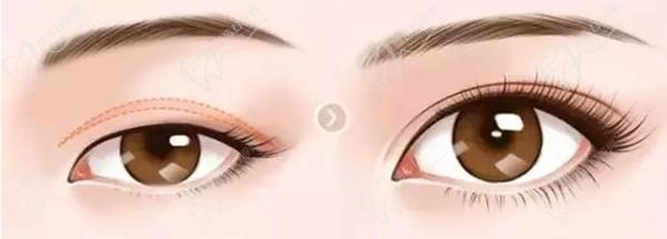 上海杜園園做眼睛失敗修復(fù)病例眾多，技術(shù)靠譜案例多，高難度眼修復(fù)難題不在話下
